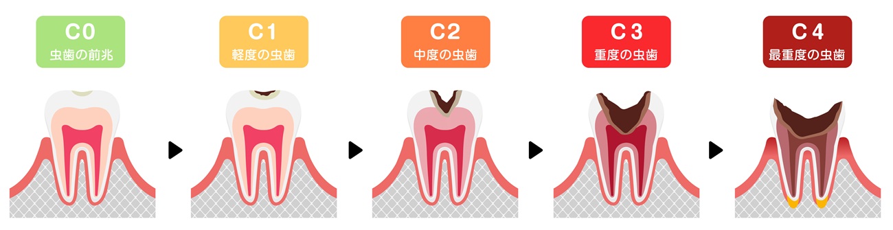 むし歯治療の程度は