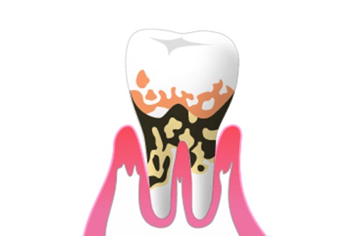 歯周病とは